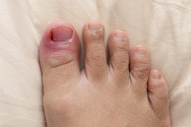 can-ingrown-toenails-be-dangerous